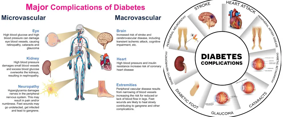 Major Complications of Diabetes Mellitus