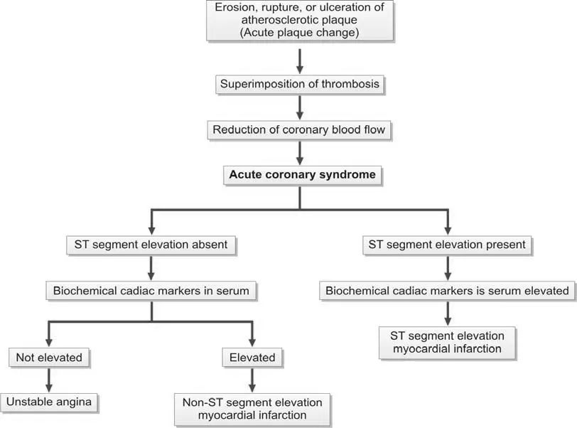 Pathogenesis and classification of acute coronary syndrome. Acute coronary syndrome results from acute reduction of myocardial blood supply due to disruption of atheromatous plaque
