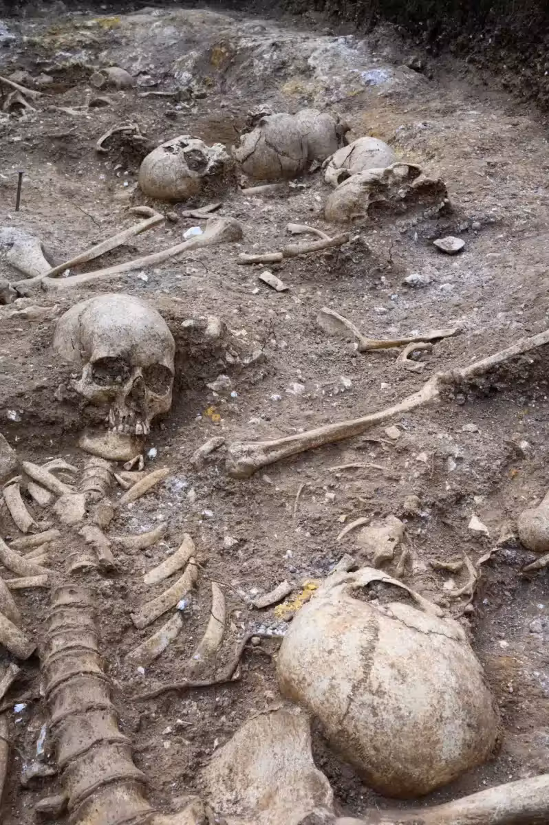 A Trepanned Skull Showing A Healed Circular Opening From An Ancient Surgical Procedure