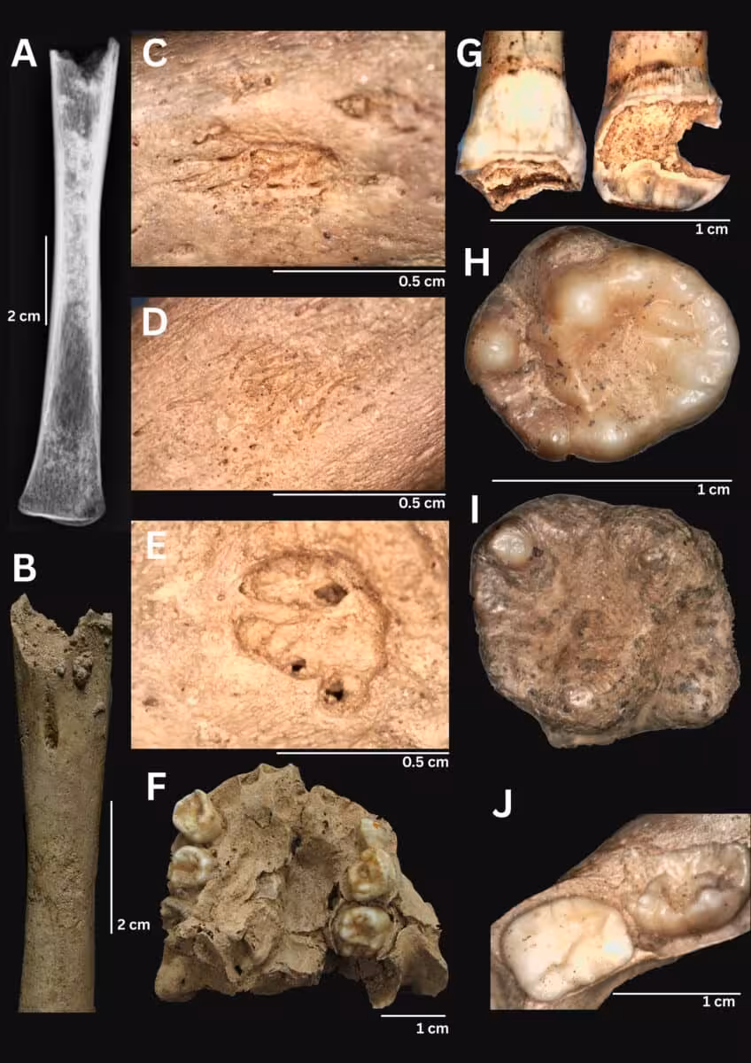 Microscopic Views And Skeletal Remains Reveal The Damage Left By An Ancient Treponemal Disease.