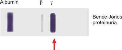 Urine protein electrophoresis showing heavy Bence Jones proteinuria