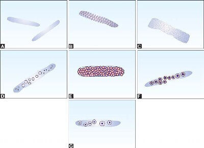 Urinary casts