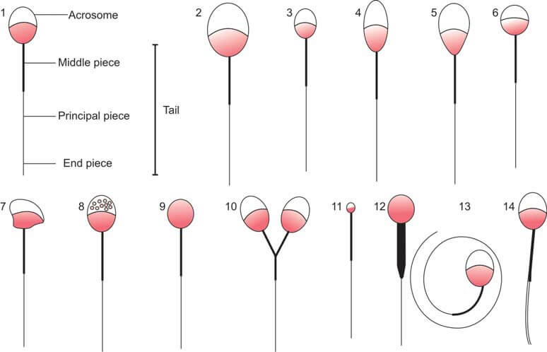 Abnormal morphological sperm forms