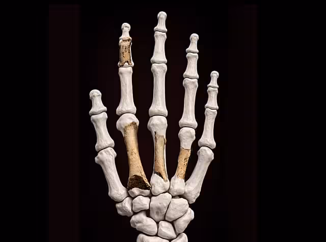 Reconstruction Of The Hand Using Preserved Bone Fragments.
