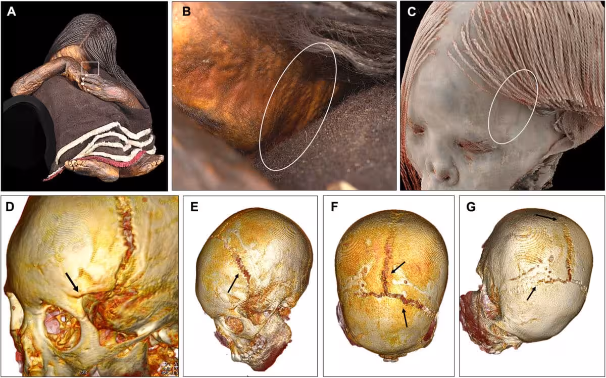 New Forensic Evidence From The Analysis Of An Inca Child Mummy.