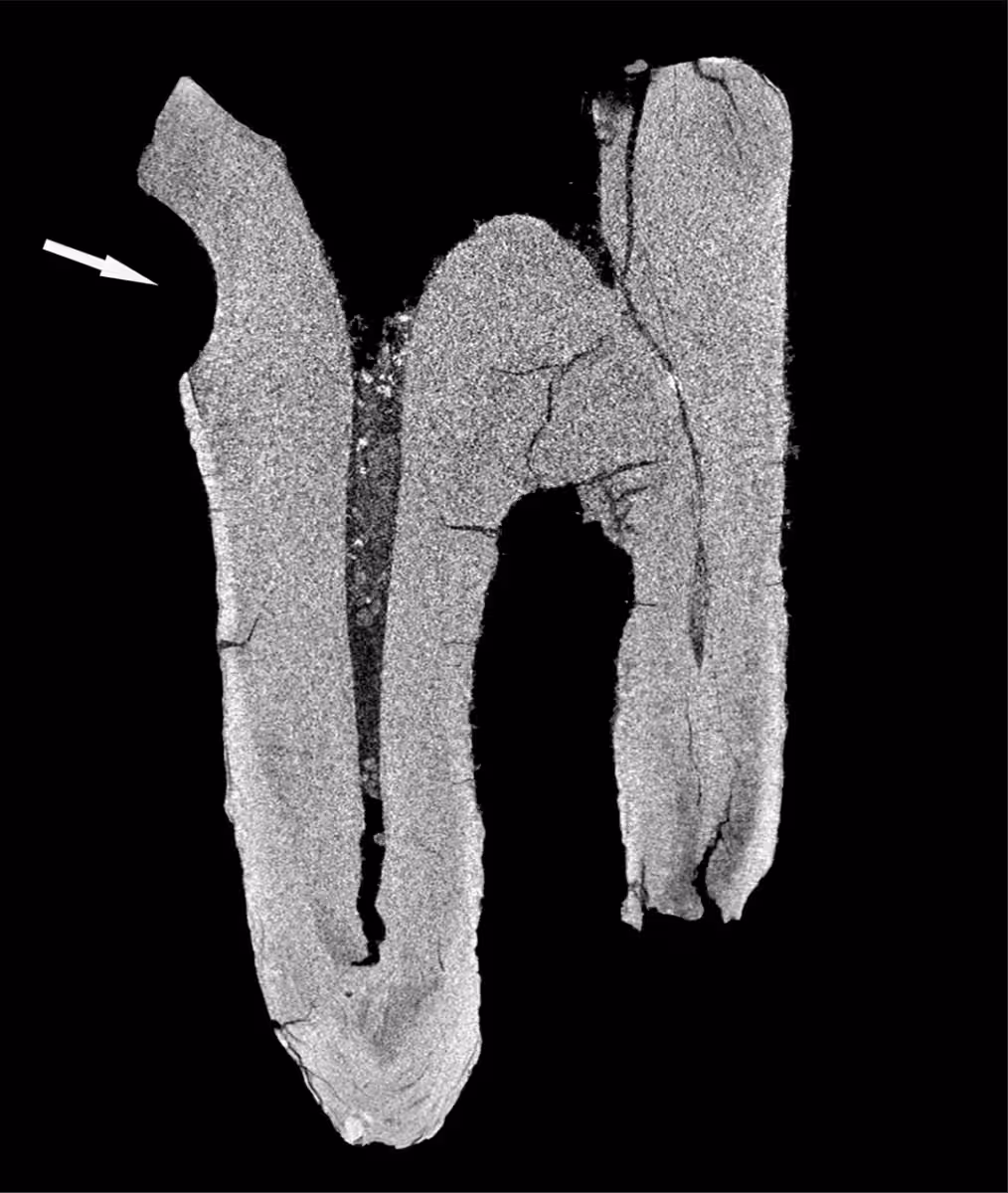 Ct Scan Of The 59,000 Year Old Neanderthal Tooth Showing A Deep Cavity Into The Pulp Chamber.