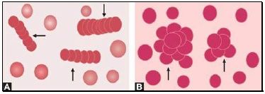 Abnormal red cell arrangement