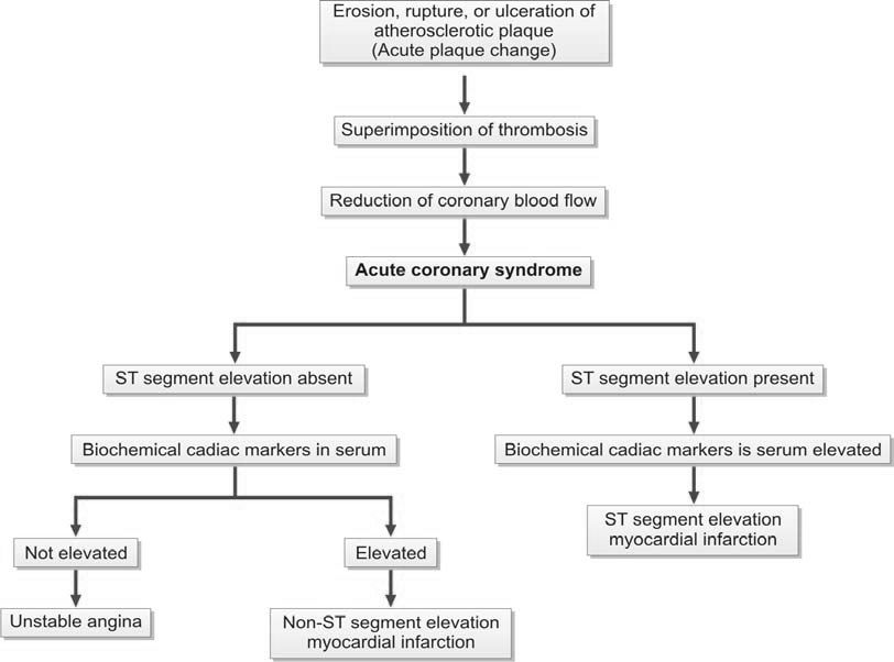 Pathogenesis and classification of acute coronary syndrome. Acute coronary syndrome results from acute reduction of myocardial blood supply due to disruption of atheromatous plaque
