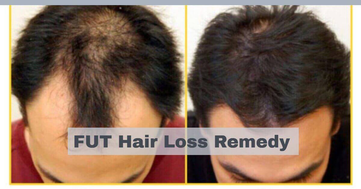FUT Hair Loss Remedy