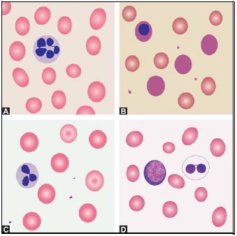 Figure 799.5 Differential diagnosis of macrocytic anemia on blood smear