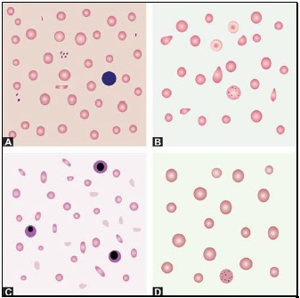 Figure 799.6 Differential diagnosis of microcytic anemia on blood smear