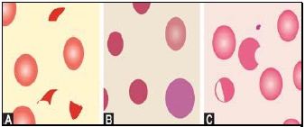 Figure 799.7 Differential diagnosis of hemolytic anemia on blood smear