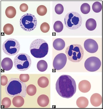 Figure 800.2 Morphological abnormalities of white blood cells