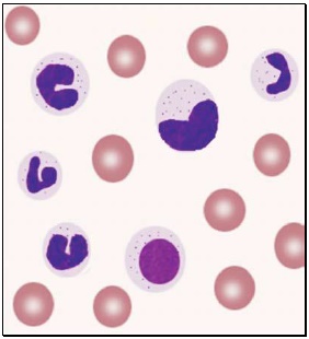 Figure 801.2 Leukemoid reaction in blood smear