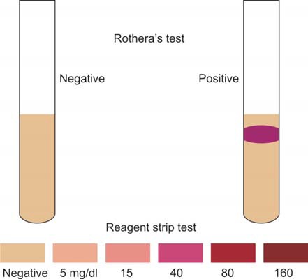 Rotheras tube test and reagent strip test for ketone bodies in urine