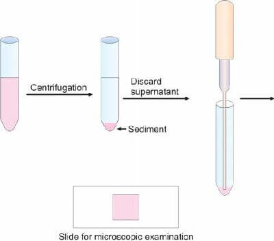 Preparation of urine sediment for microscopic examination