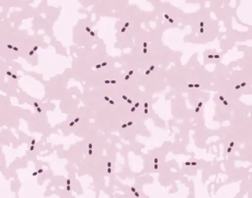 Gram stained smear of sputum showing gram positive diplococci (Streptococcus pneumoniae)