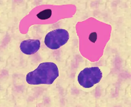 Sputum examination showing malignant cells of squamous type