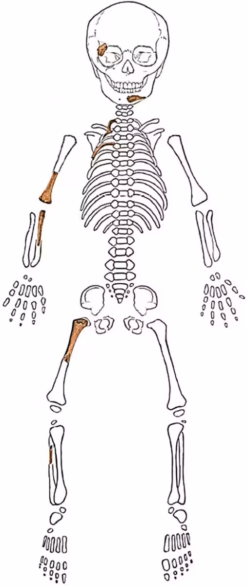 Diagram Showing The Reconstructed Neanderthal Fetal Skeleton. Brown Sections Indicate The Fossilized Bones Recovered From The Bavarian Cave Site.