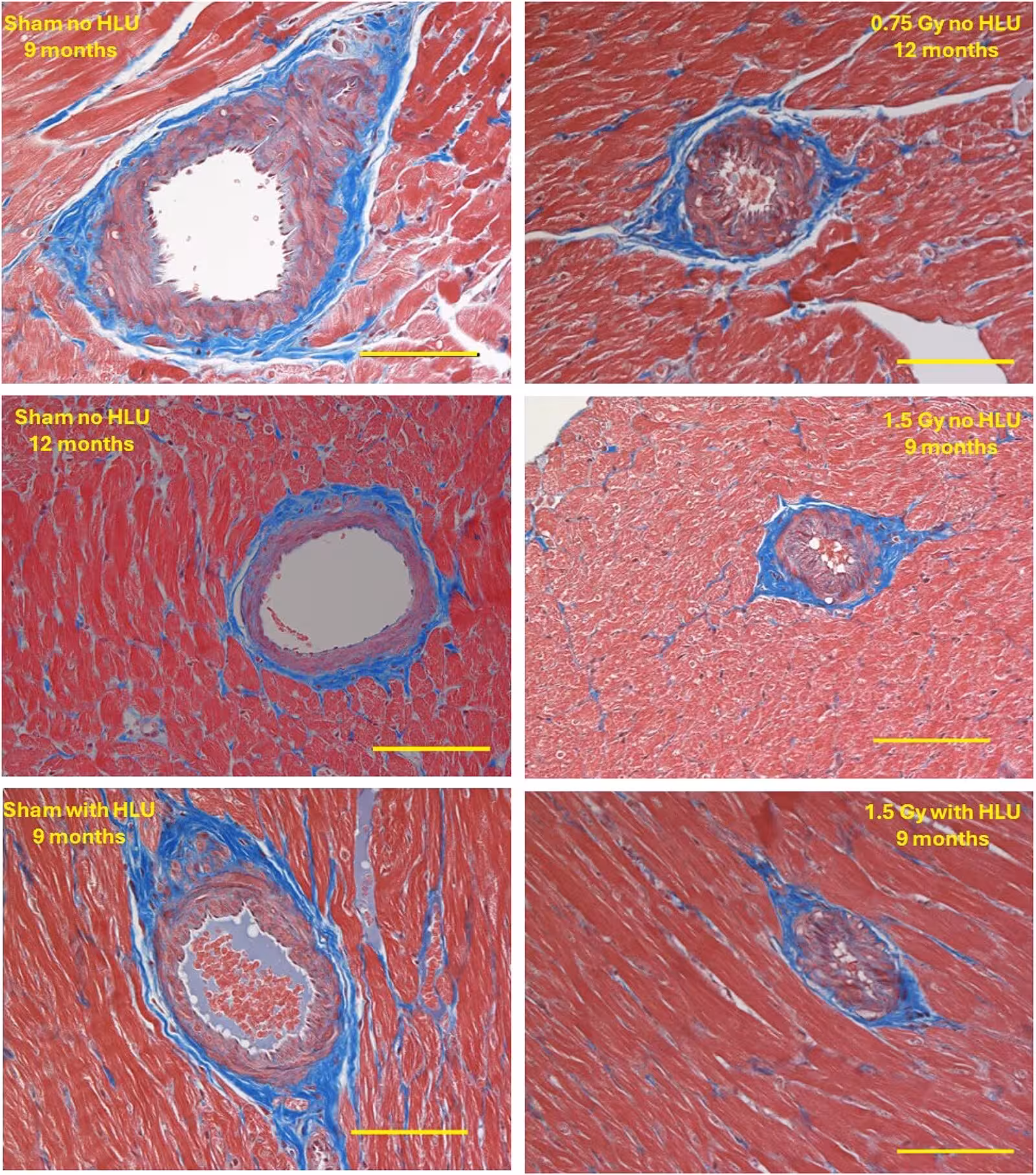 Fig 1: Structural changes in the heart 270 days and 360 days after simGCRsim and HLU or sham irradiation no HLU. Rats were irradiated with 0.75 Gy or 1.5 Gy simGCRsim with no HLU, 1.5 Gy with HLU and compared with no HLU or sham-irradiated groups. Rats were 8-9 months of age at the start of the study and 17-18 or 20-21 months at the end. Heart sections were stained with Trichrome. The horizontal bar represents 100 microns. Images are representative of data from 3-6 animals per group. n = 3-6 animals per group.