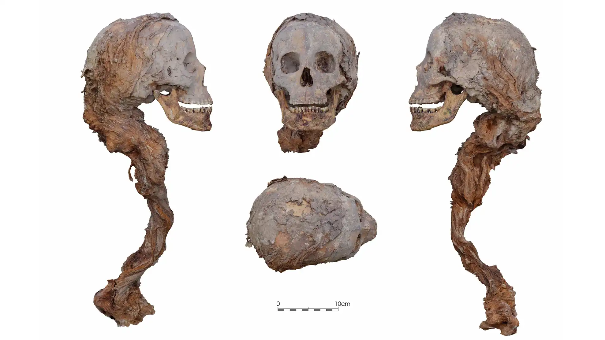 four views of a human skull with a ponytail still attached