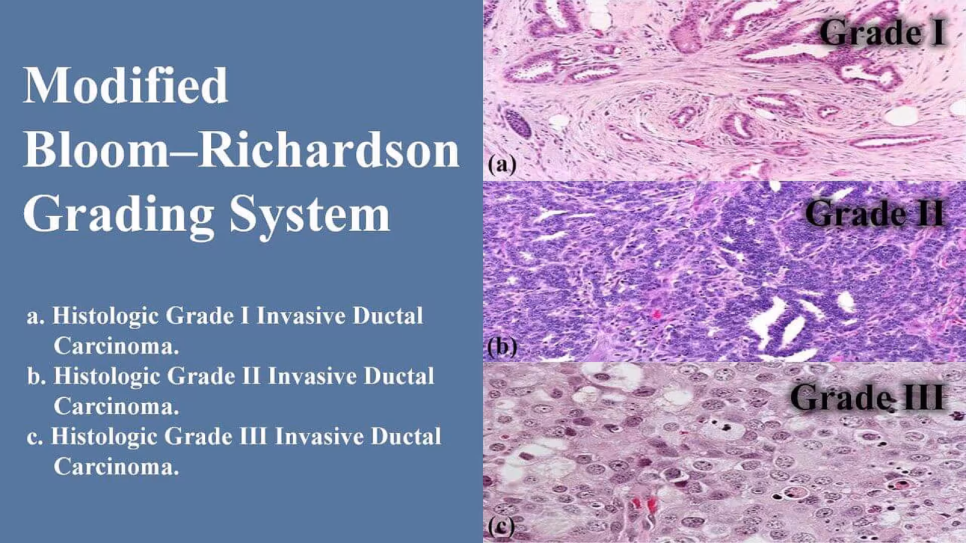 Breast Histopathology of Grade I, II and III invasive ductal carcinoma