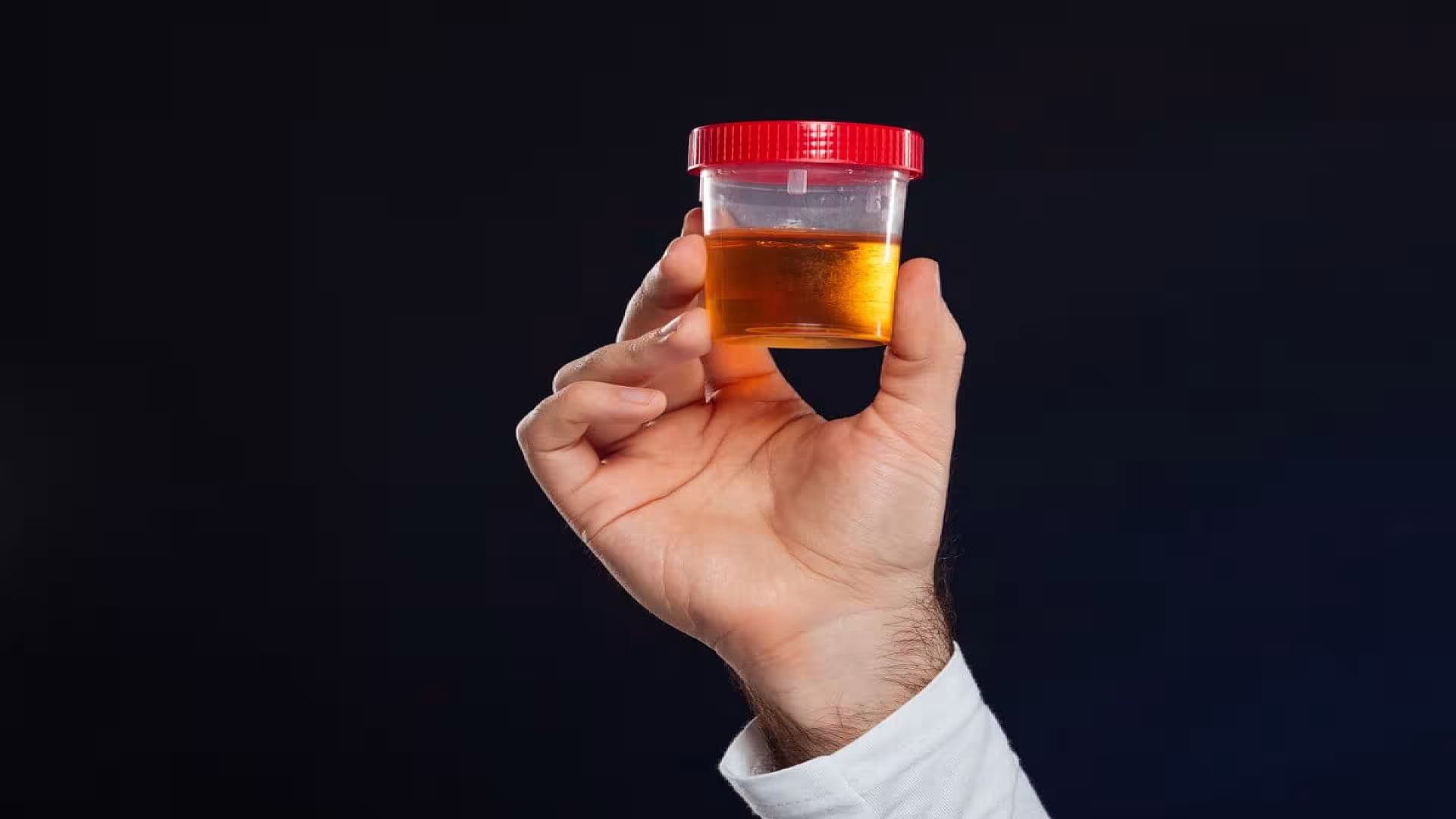 Urine Protein Electrophoresis