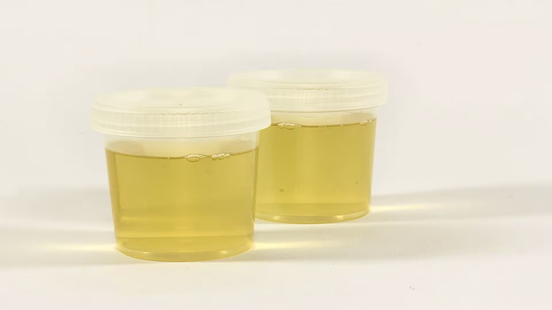 Urine Specimen for Rothera’s Test