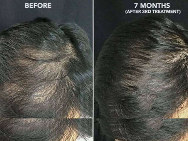 Platelet-rich plasma, also known as PRP, is a promising treatment for androgenic alopecia, a type of hair loss. Some people experience significant improvement after several sessions. Images via Dr. Usha Rajagopal, San Francisco Plastic Surgery and Laser Center.