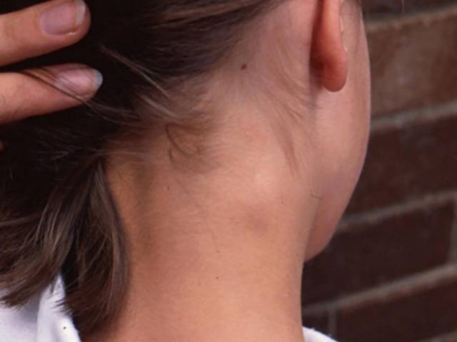 Swollen lymph nodes on back of neck