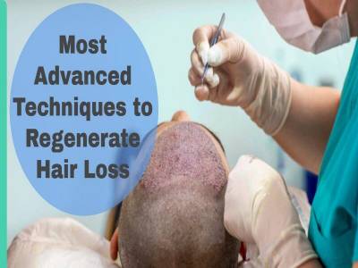 Most Advanced Techniques to Regenerate Hair Loss