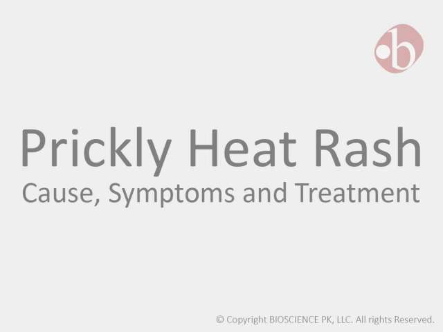 Prickly Heat Rash: Cause, Symptoms and Treatment