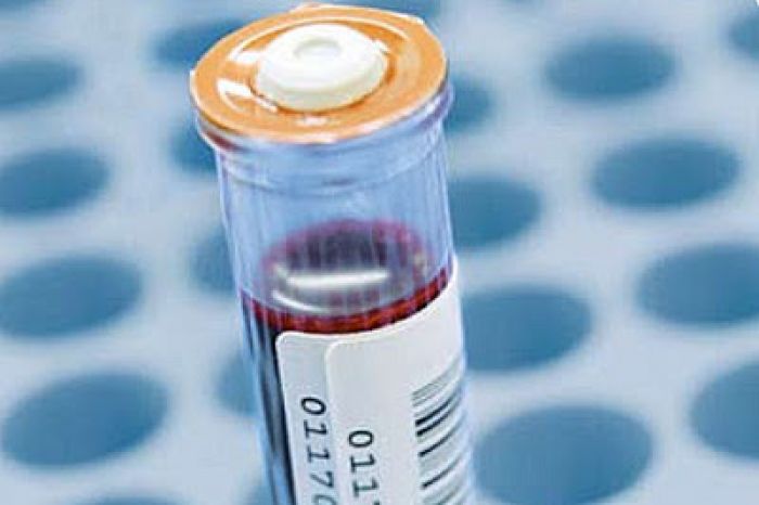 Blood Test for Colorectal Cancer - Epigenomics AG | Source: Medscape