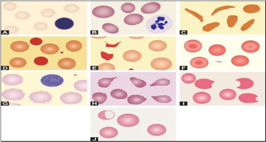 Figure 799.1: Variations in size and shape of red cells: (A) Microcytic hypochromic red cells in iron deficiency anemia; (B) Oval macrocytes and a hypersegmented neutrophil in megaloblastic anemia; (C) Sickle cells in sickle cell anemia; (D) Spherocytes in hereditary spherocytosis; (E) Fragmented red cells or schistocytes in microangiopathic hemolytic anemia; (F) Target cells in hemoglobinopathy; (G) Burr cells in chronic renal failure; (H) Tear drop red cells in myelofibrosis; (I) Bite cells and (J) Blister cell in glucose-6-phosphate dehydrogenase deficiency