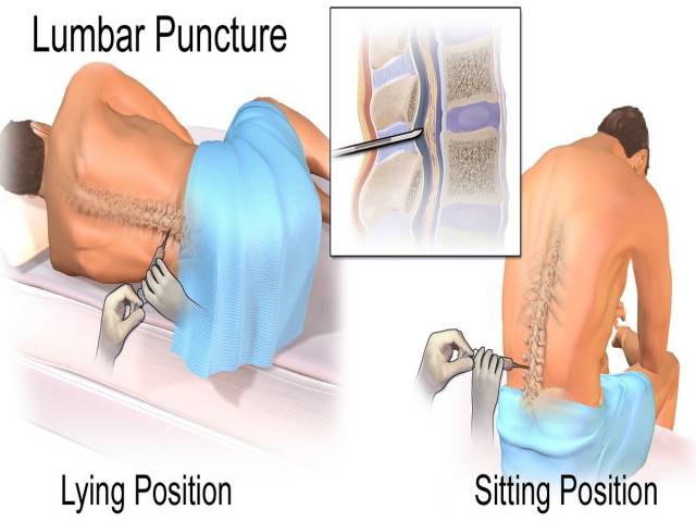 Lumbar Puncture: (A) Lying position (B) Sitting position
