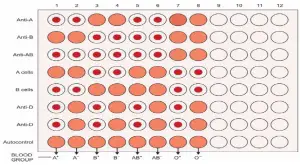 FIGURE 787.1: Microplate (96 well) method for blood grouping. Numbers 1 to 12 represent patient identification numbers. Reagents added to the patient sample are written on left, while interpretation (blood group of patient) is written at the bottom. For understanding, reaction patterns of the 8 possible blood groups are shown, while the last 4 columns have been kept empty. Red compact button indicates agglutination, while uniform suspension indicates no agglutination