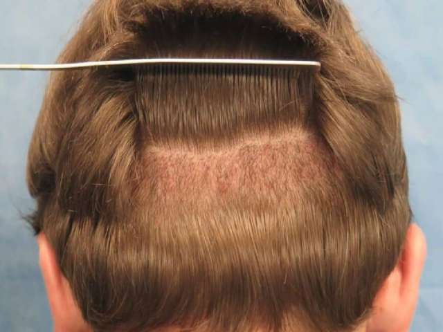 What to Know When Choosing FUE Hair Transplant?