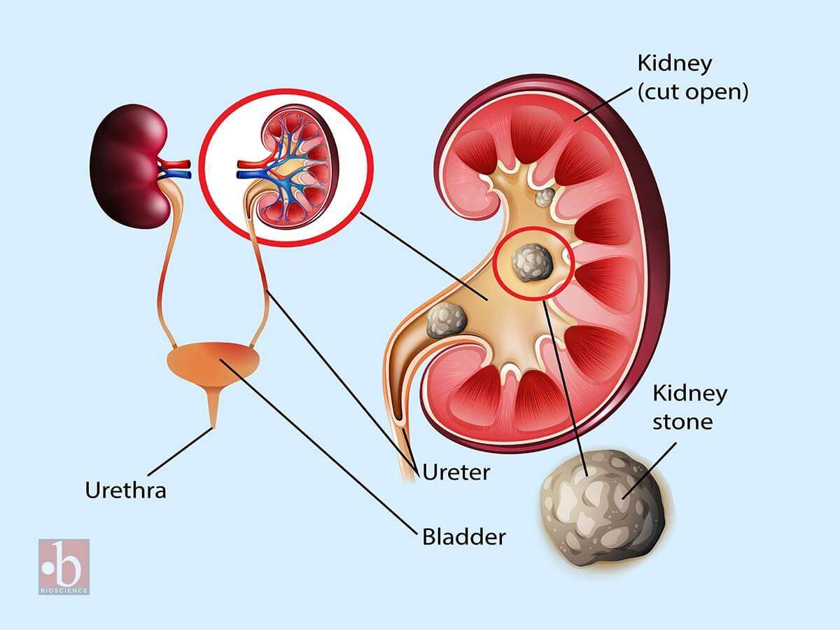 Free vector informative illustration of kidney stones.