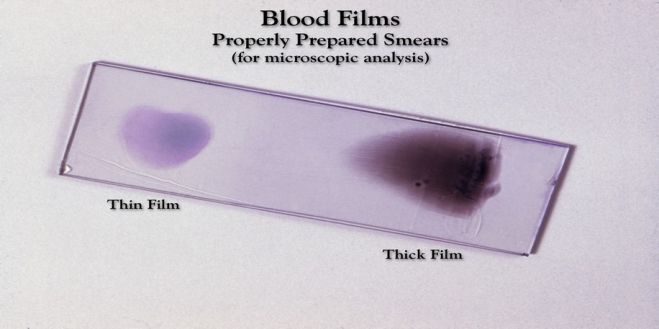 Blood Films (Properly Prepared Smears) for Microscopic Examination