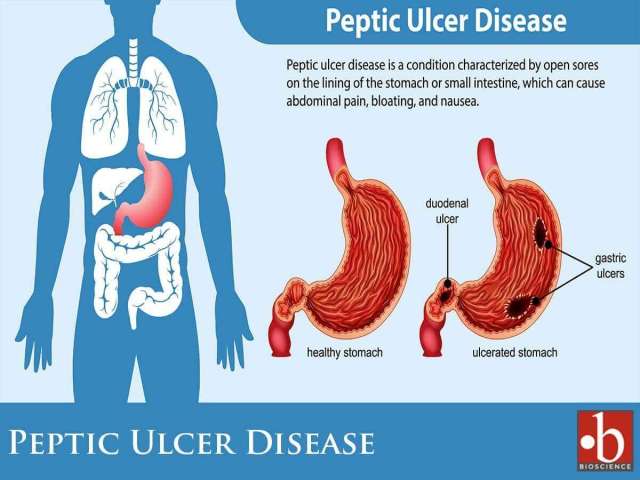Free vector peptic ulcer disease infographic.