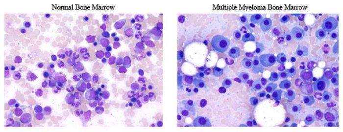 Multiple Myeloma Cancer Bone Marrow Smear | Image Source: Thrombocyte.Com