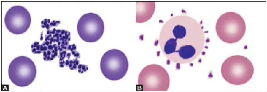 Figure 802.1 Causes of false thrombocytopenia on automated hematology analyzer: (A) Clumps of platelets; (B) Platelet satellitism