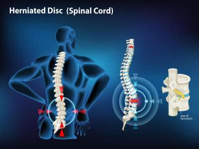 Diagram showing herniated disc in human.