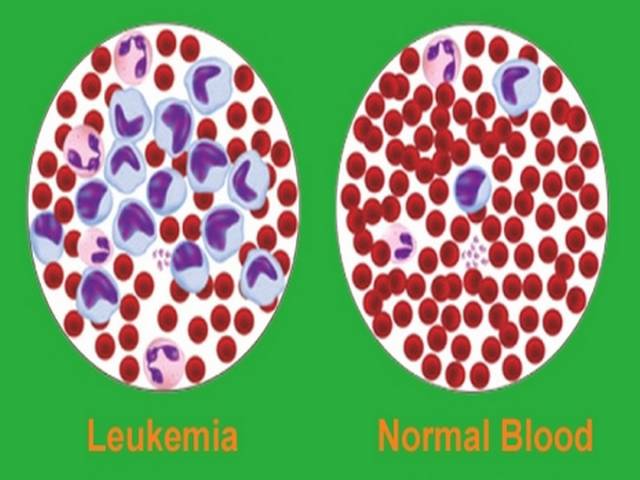 Leukemia Vs Normal Blood