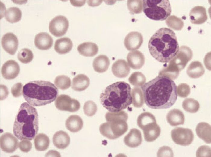 Neutrophil disorders and their management | Source: Lakshman and Finn 54 (1): 7 -- Journal of Clinical Pathology