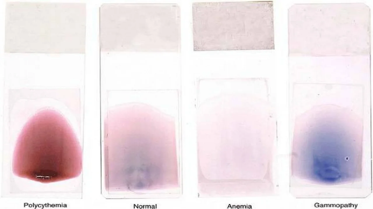 Peripheral Blood Smear: The color of blood smears can reflect severe underlying abnormalities in hematocrit and the presence of abnormal circulating immunoglobins.
