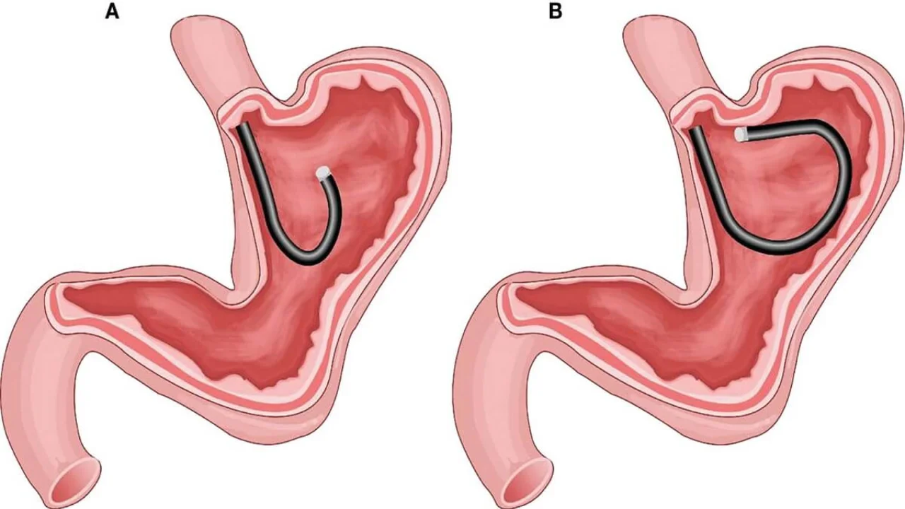 (A) Depicts the gastric fundus and cardia viewed through the conventional U-turn technique, where the gastroscopy body is suspended without support. (B) Shows endoscopic advancement just below the gastric cardia utilizing the forward-return method along the greater curvature wall (FRW technique), with the gastroscopy body supported by the gastric wall.