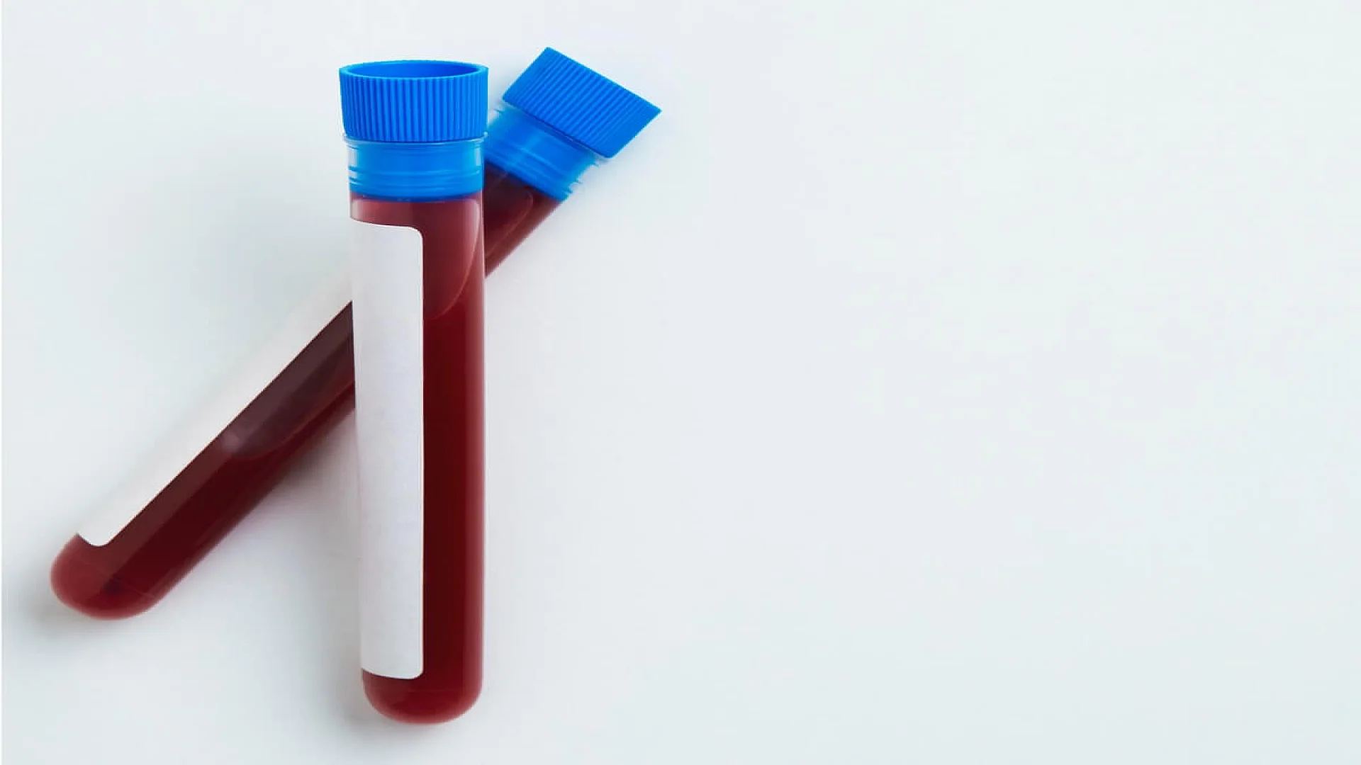 Blood Sample for Glucose Estimation by Folin-Wu Method