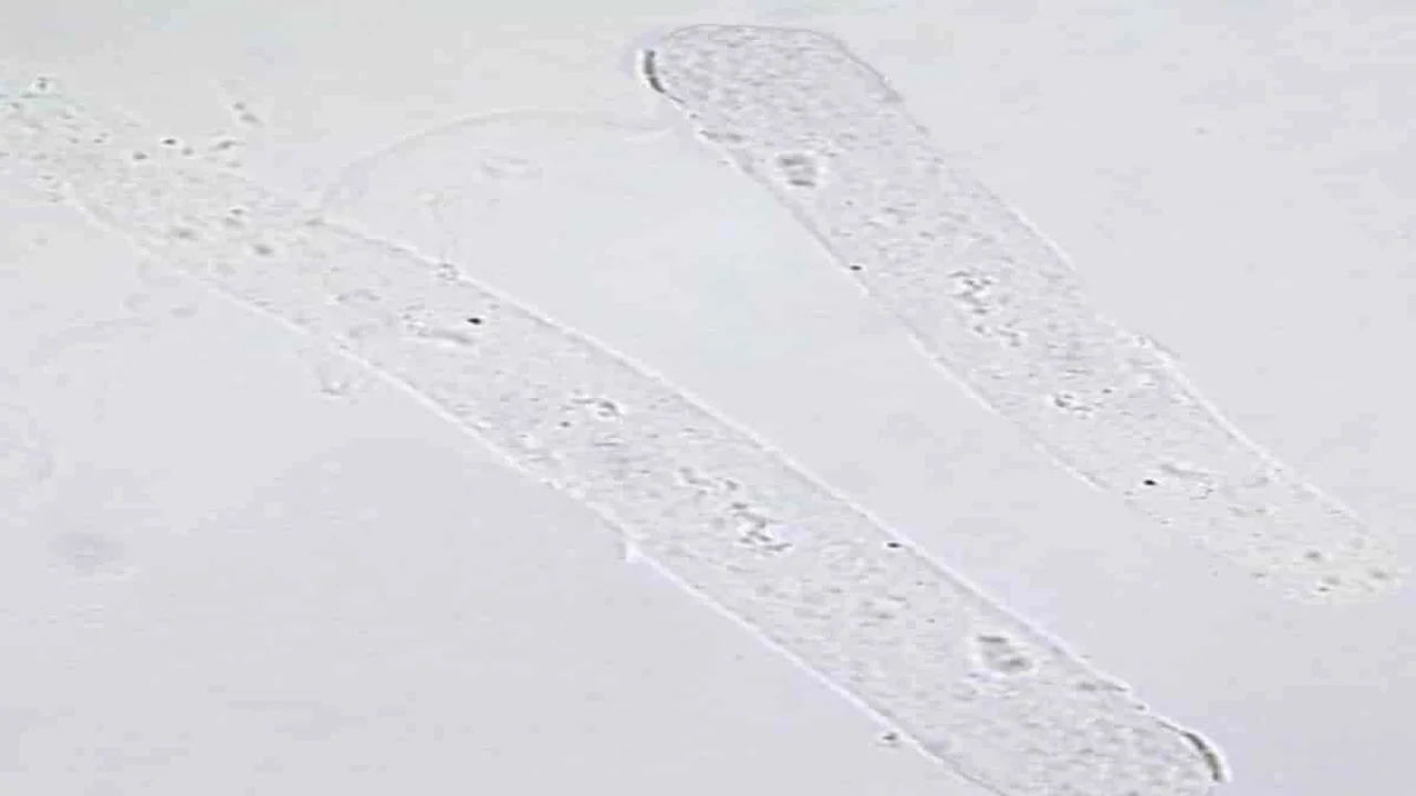 Hyaline Casts