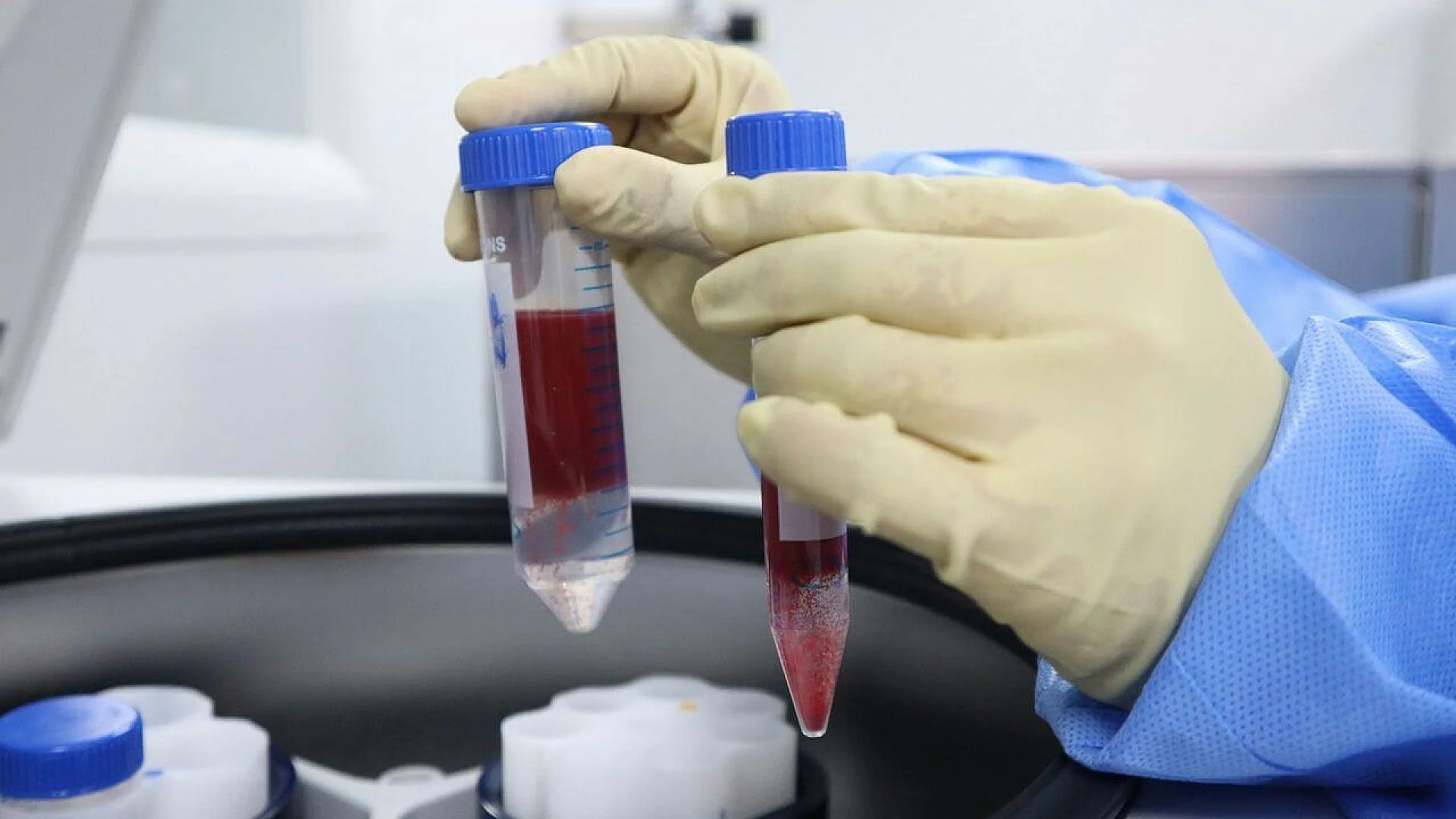 Gloved hands hold two centrifuge tubes containing stratified blood samples over a laboratory rotor. The image represents the analytical process used to separate genuine medical links from statistical bias.